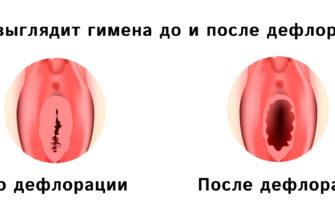 Операция по хирургической дефлорации девственной плевы