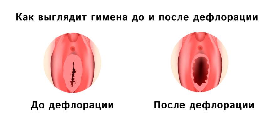 Операция по хирургической дефлорации девственной плевы
