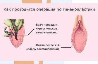 Операция гименопластика - восстановление девственной плевы
