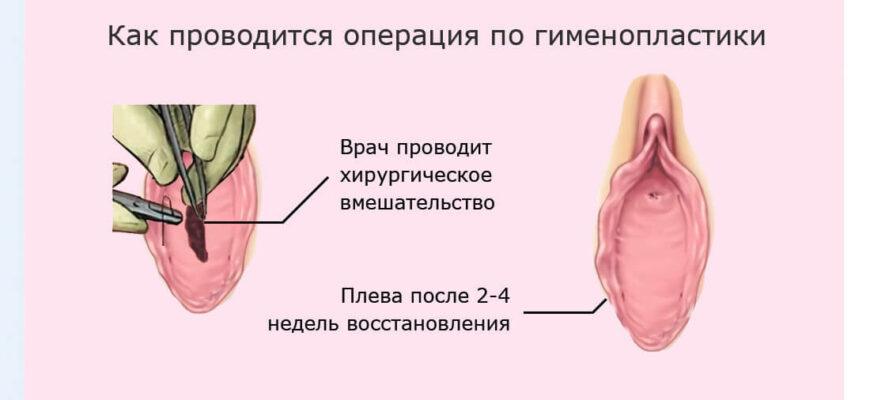 Операция гименопластика - восстановление девственной плевы